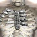 В России созданы искусственные кости, которые подойдут любому человеку
