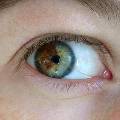 По цвету глаз можно диагностировать болезни кожи