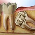 Учёные выяснили, почему у некоторых людей отсутствуют «зубы мудрости»